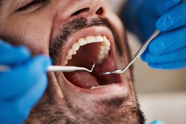Best Broken or Chipped Tooth Repair in USA